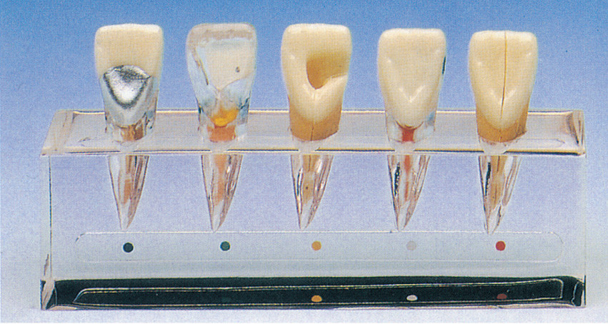 Clinical Tooth Disease Series Model about 5 Parts for Dental Schools Training